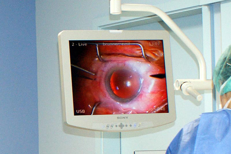 Dr. med. Alina Goth - Augenärztin - Behandlung Grauer Star